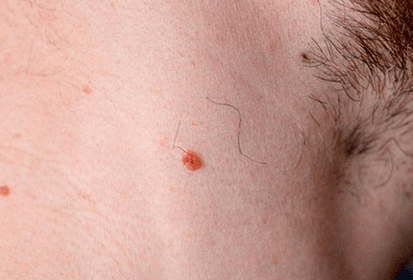Papilloma