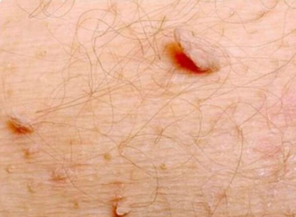 Papillomas afiados no corpo humano