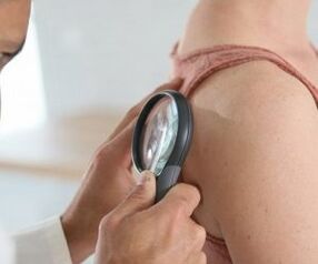 Como determinar o virus do papiloma humano