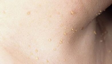 risco de desenvolver papilomatose no pescozo