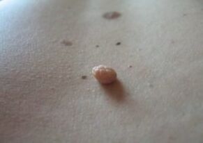 O papiloma é un crecemento na superficie da pel