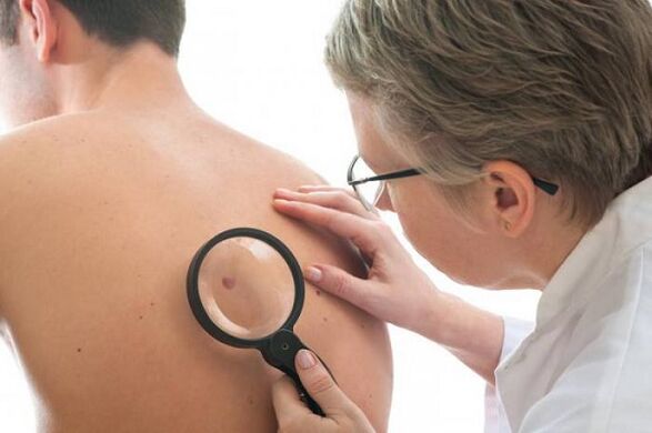 o médico examina o papiloma nas costas