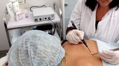 Electrocoagulación como método para eliminar as verrugas